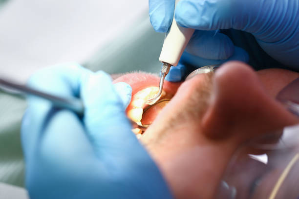 Best Emergency Dentist for Lost Fillings or Crowns in Ancient Oaks, PA